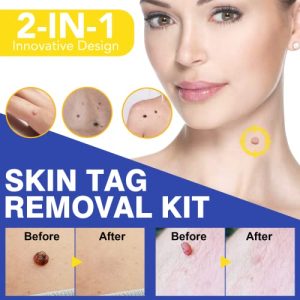 Stielwarzen-Entferner IDUCEN Skin Tag Remover